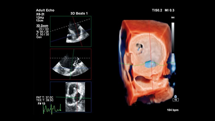 Cardiac ultrasound scan TrueVue anatomical intelligence