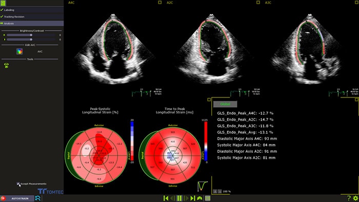 EchoNavigator in cardiac ultrasound machine