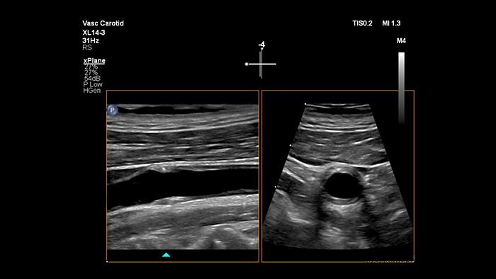 Example of an image retrieved with xPlane imaging vascular ultrasound Philips