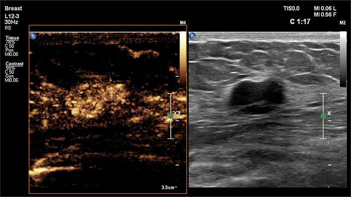 Image with the breast ultrasound
