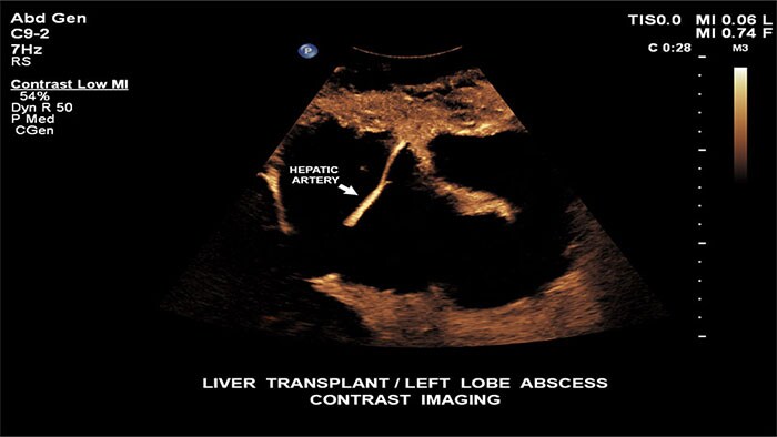 Image liver transplant
