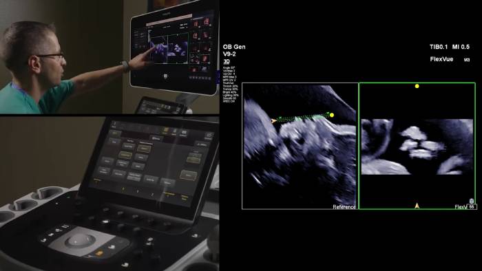 Philips FlexVue and Orthogonal View Demonstration by Dr. Michael Ruma