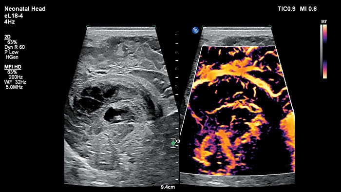 Pediatric Ultrasound Solution Philips