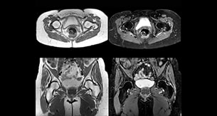 Lefebvre Case3 Hip MRI thmb