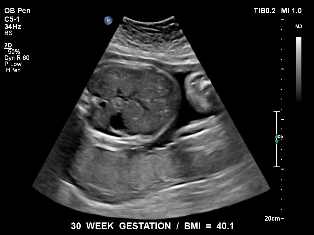 ultrasound first trimester image clinical