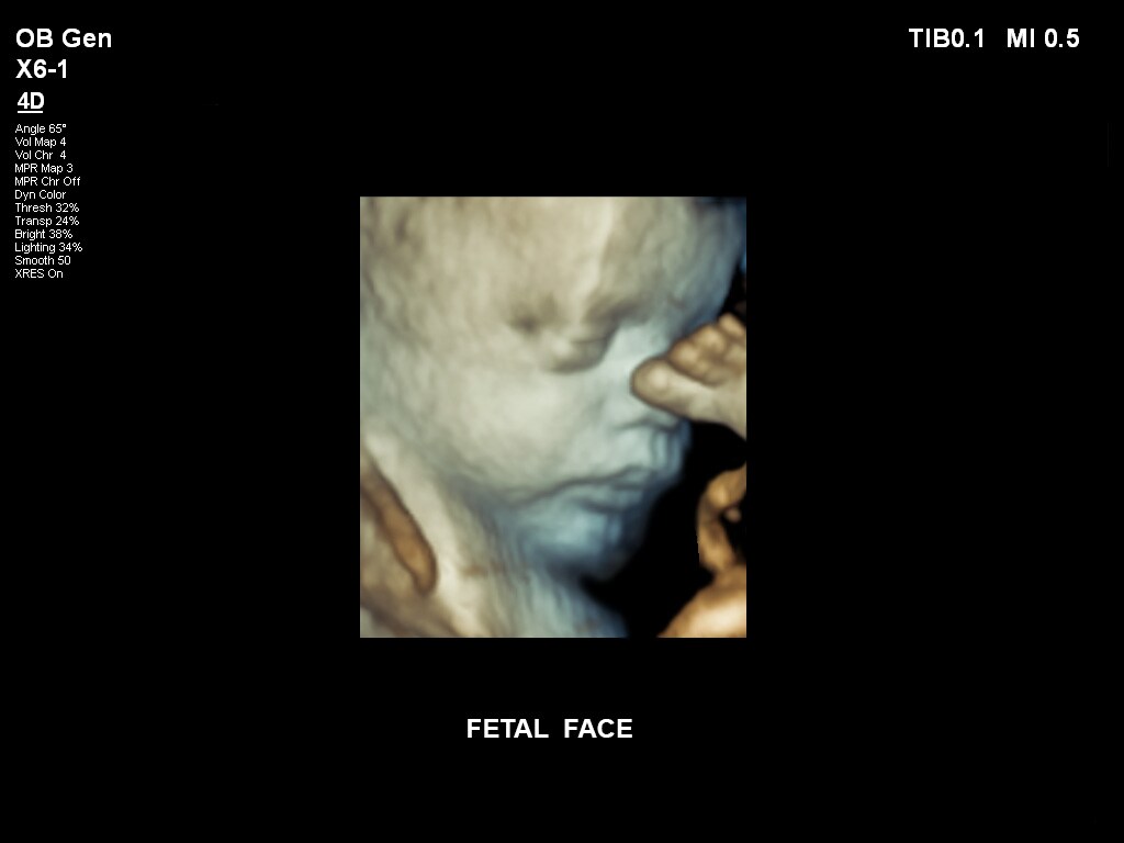 ultrasound first trimester image clinical