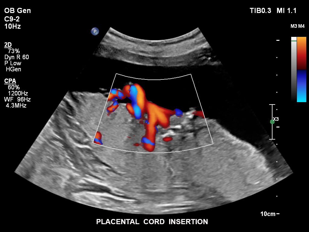 ultrasound first trimester image clinical