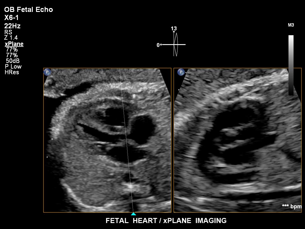 ultrasound first trimester image clinical