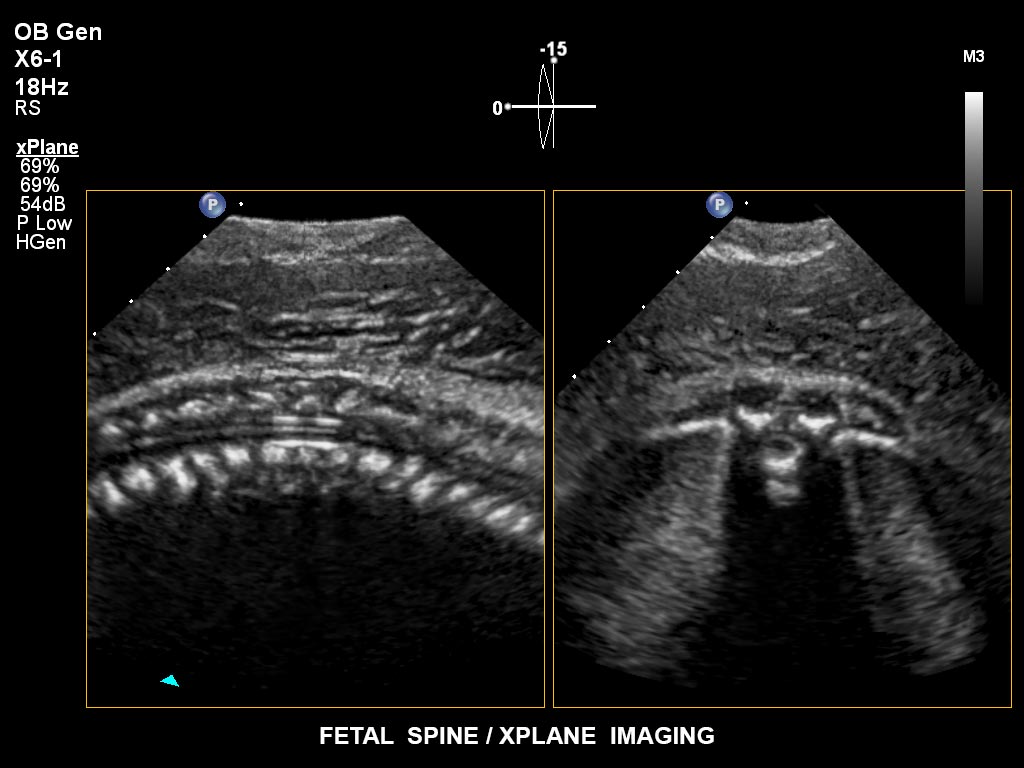 ultrasound first trimester image clinical