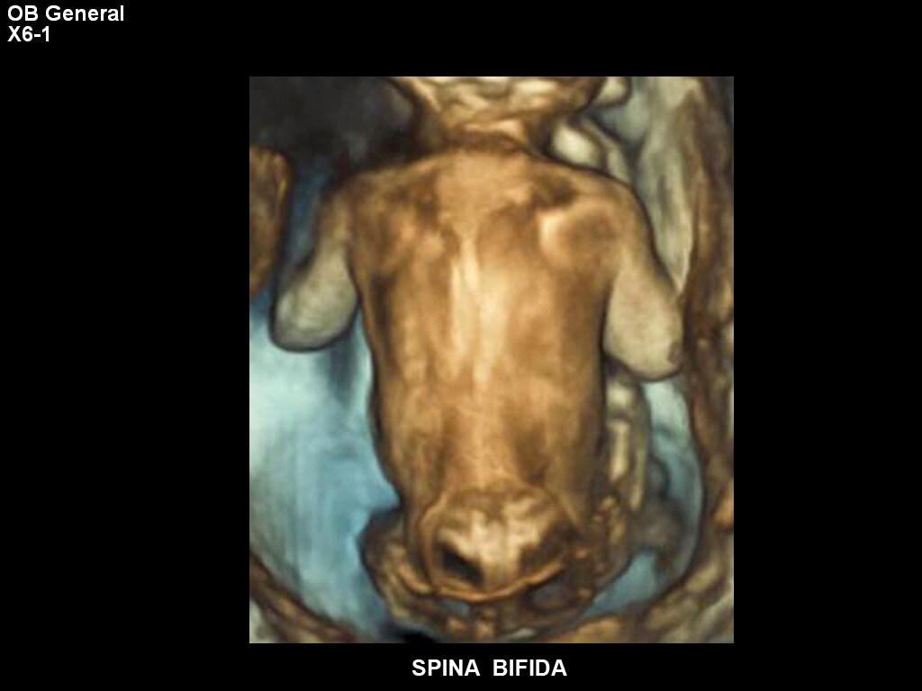 ultrasound first trimester image clinical