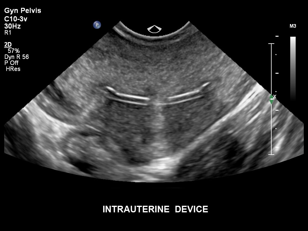 ultrasound first trimester image clinical