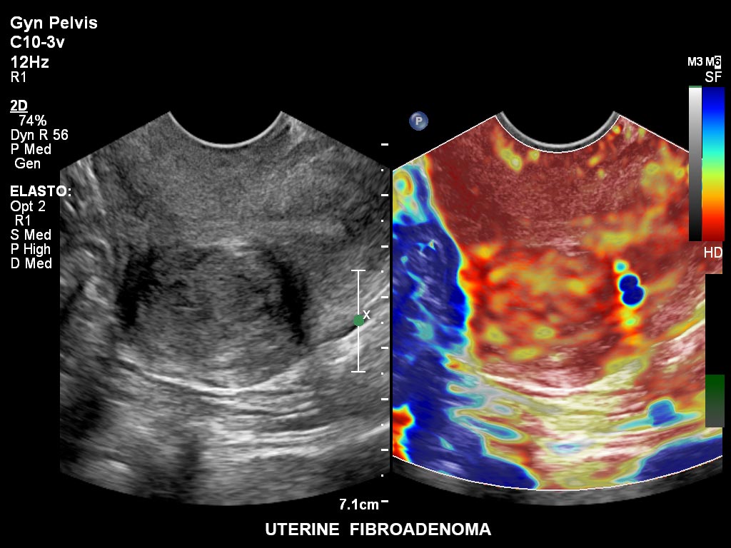 ultrasound first trimester image clinical