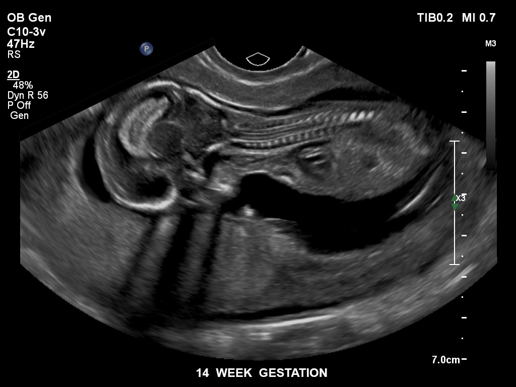 ultrasound first trimester image clinical