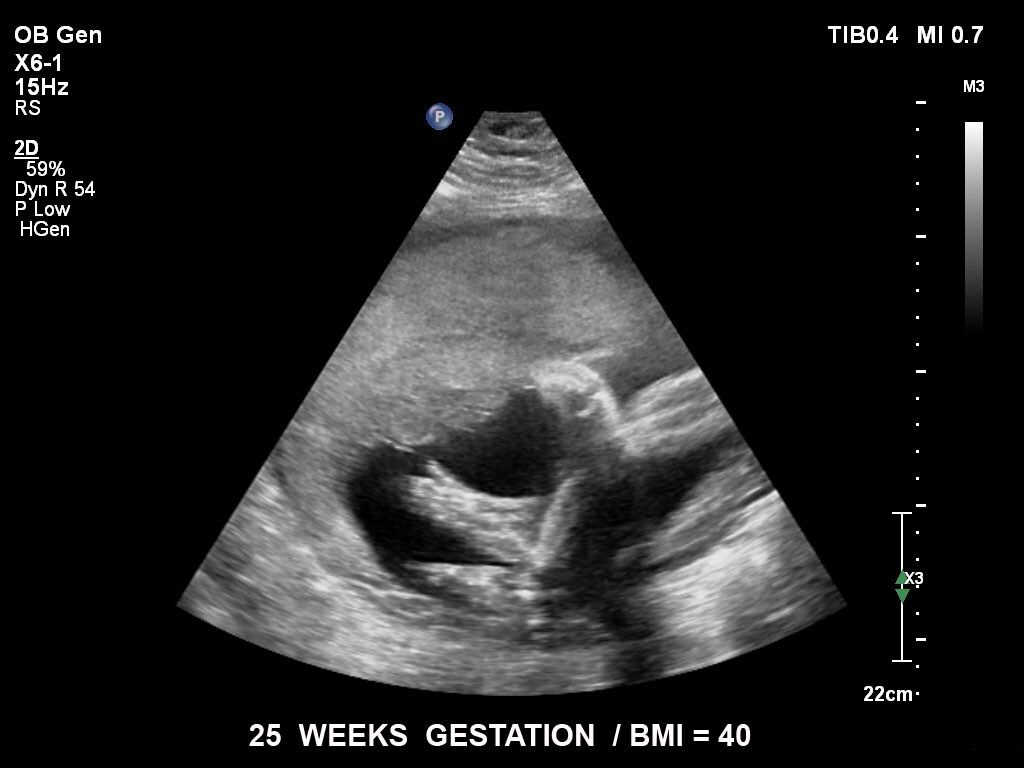 ultrasound first trimester image clinical