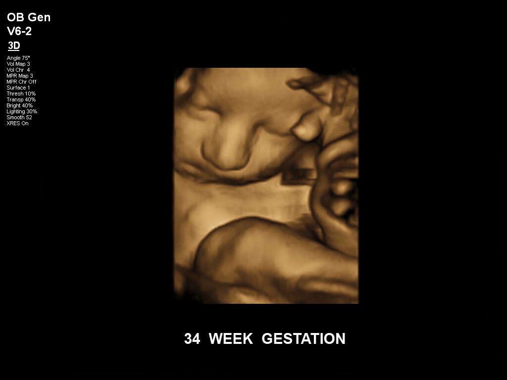 ultrasound first trimester image clinical