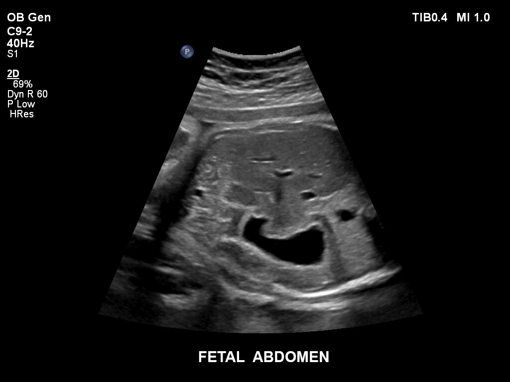 ultrasound first trimester image clinical