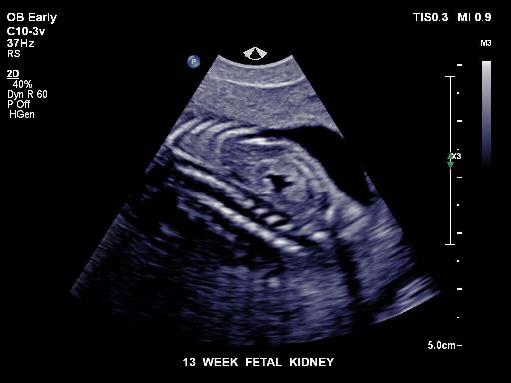 ultrasound first trimester image clinical