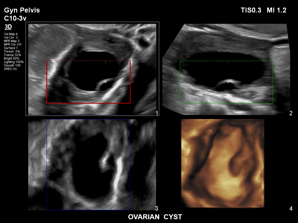 ultrasound first trimester image clinical