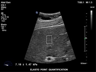 elastPQ clinical image