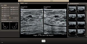 Automatic orthogonal plane dual image view with Philips AI Breast feature