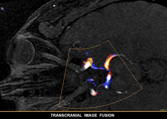 Transcranial image fusion