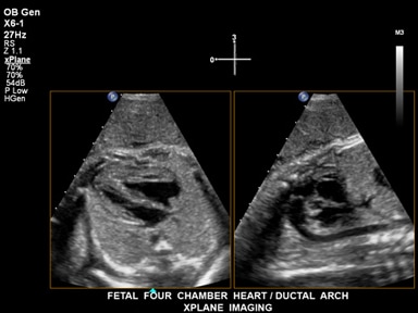 Fetal four chamber heart / ductal arch, xplane imaging