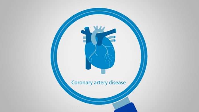 Coronary artery disease video
