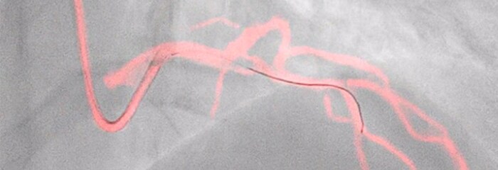 Closeup view of coronary roadmap