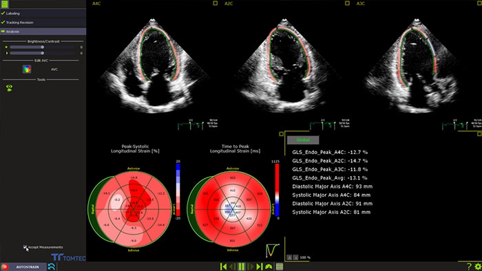 Serving the Heart: The Impact of 3D and Strain Echocardiography for COVID-19 patients
