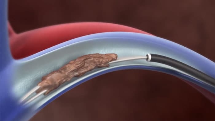 TightRail rotating dilator sheath