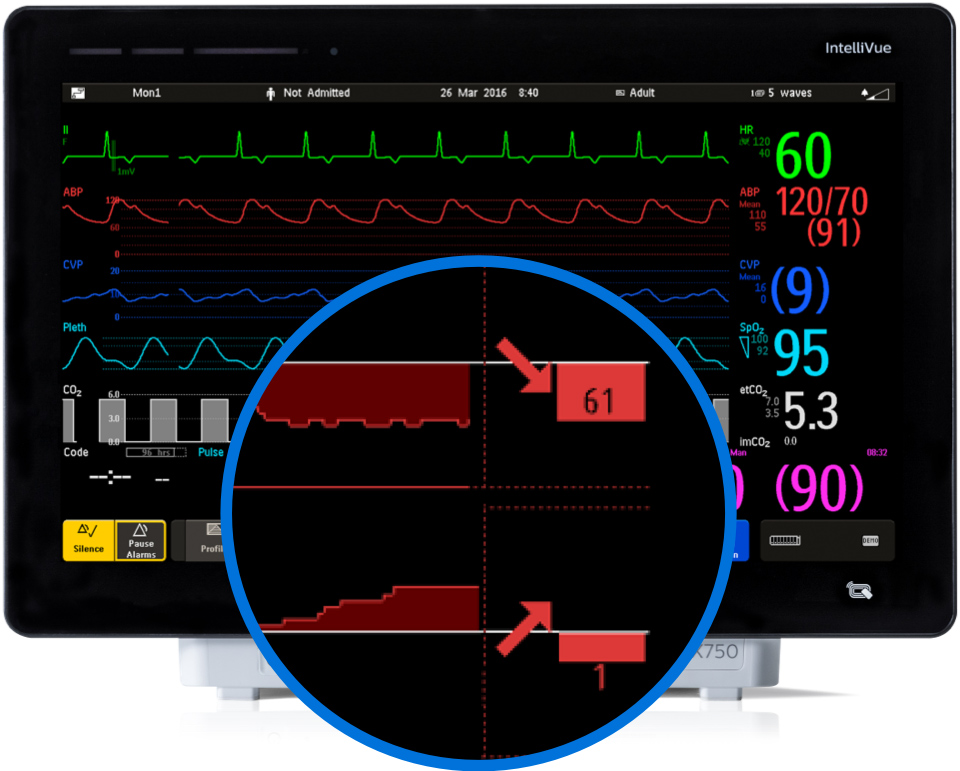 Screen Trends Patient monitoring decision support