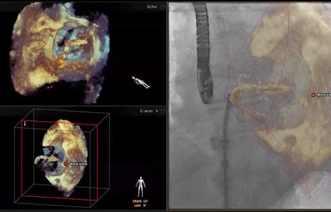 Linked live 3D TEE and x-ray scan.