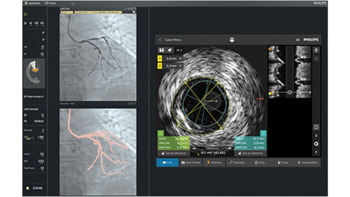 IntraSight Intervantional platform