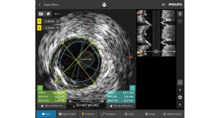 IVUS imag