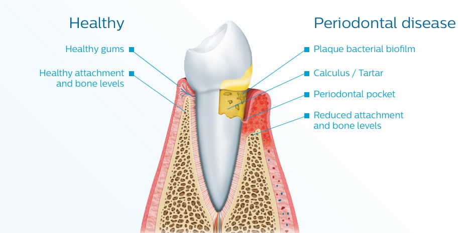 Periodontal Disease Philips