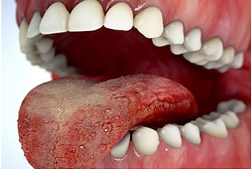 Oral malodor | Philips Oral Healthcare