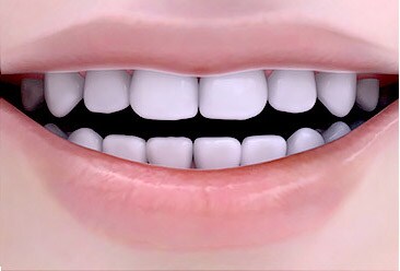 whitening