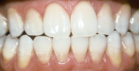 sonicare toothbrush before and after