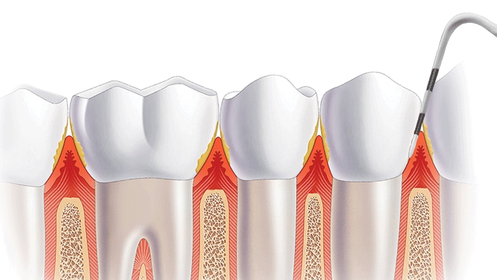 A comparison of the effects of scaling and root planing, plus twice-daily toothbrushing, in a stage I/II periodontitis population