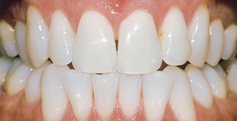 Teeth Whitening Scale Chart