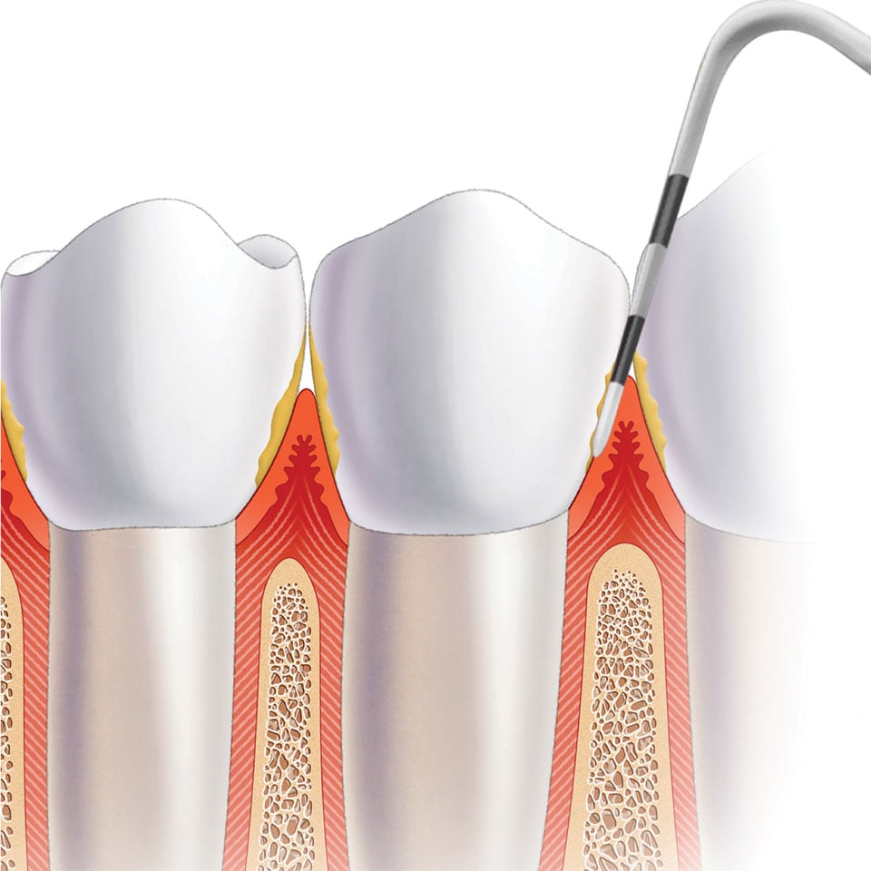 Periodontitis clinical image
