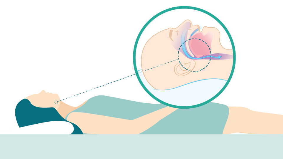 Nightbalance Cpap Alternative Philips