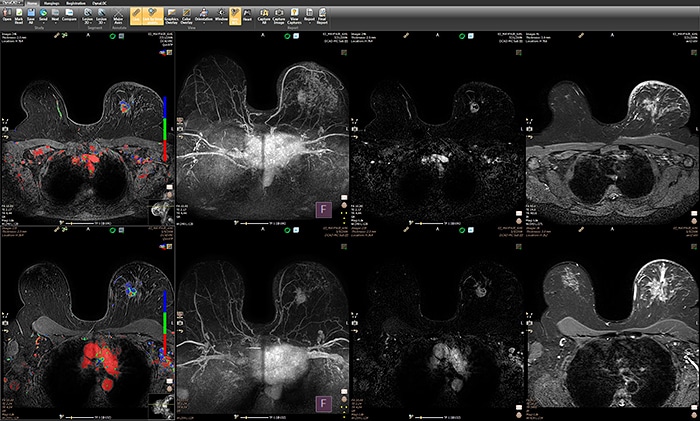 Download image (.jpg) IntelliSpace Enterprise isp10 DynaCAD Breast Current Prior Layout (opens in a new window)