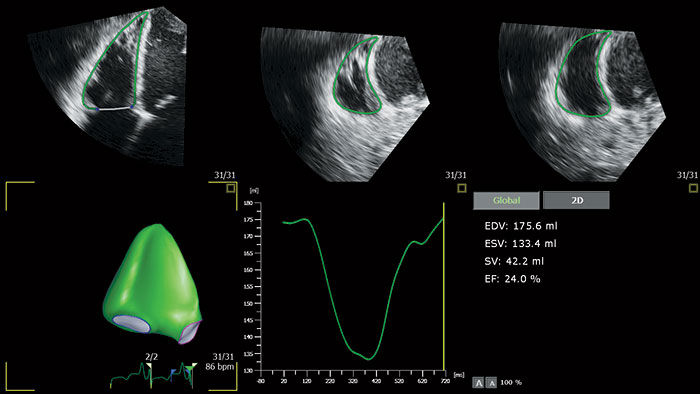 New cardiovascular ultrasound Affiniti CVx - News | Philips