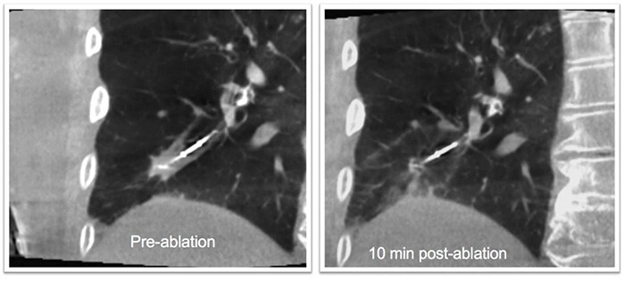Download image (.jpg) Philips Azurion lung ablation (opens in a new window)
