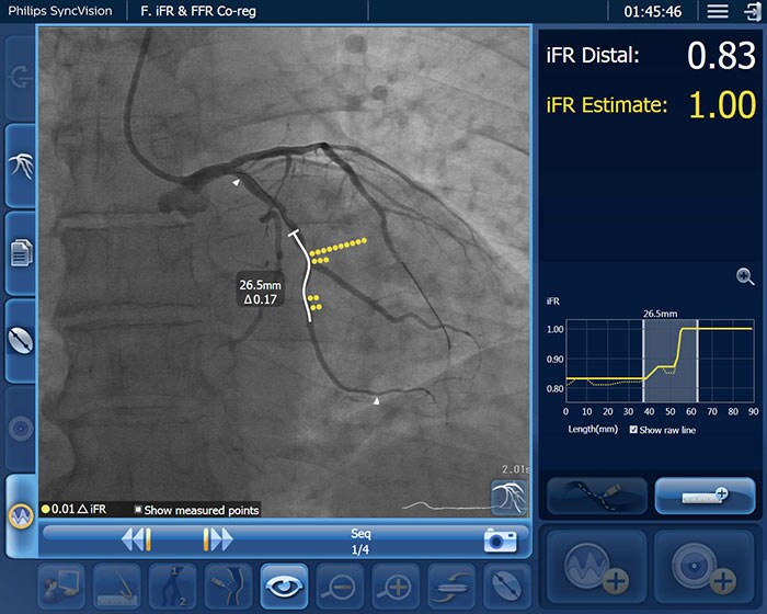 Download image (.jpg) iFR data co registered on the angiogram (opens in a new window)