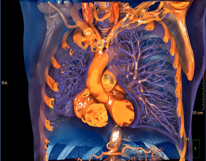 Download image (.jpg) : IntelliSpace Portal 12 Photorealistic Chest 3D Image (opens in a new window)
