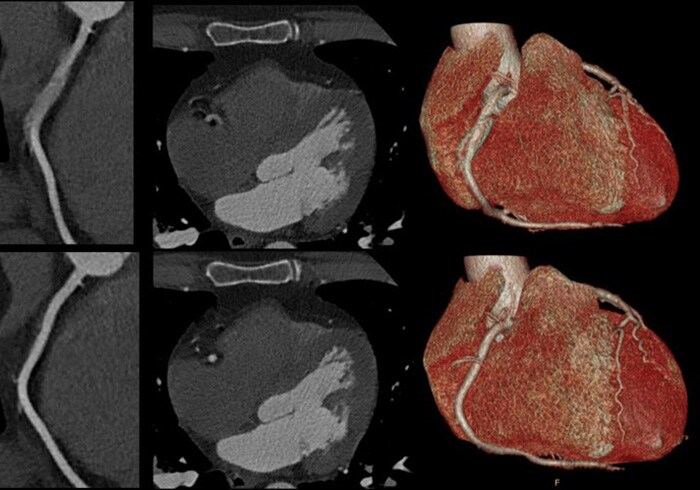 Download image (.jpg) Spectral CT 7500 Motion in Right Coronary Artery Comparison (opens in a new window)
