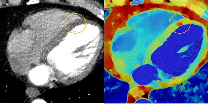 Download image (.jpg) Spectral CT 7500 Myocardial Perfusion Comparison (opens in a new window)