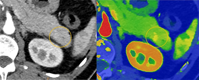 Download image (.jpg) Spectral CT 7500 Pancreatic Lesion Comparison (opens in a new window)